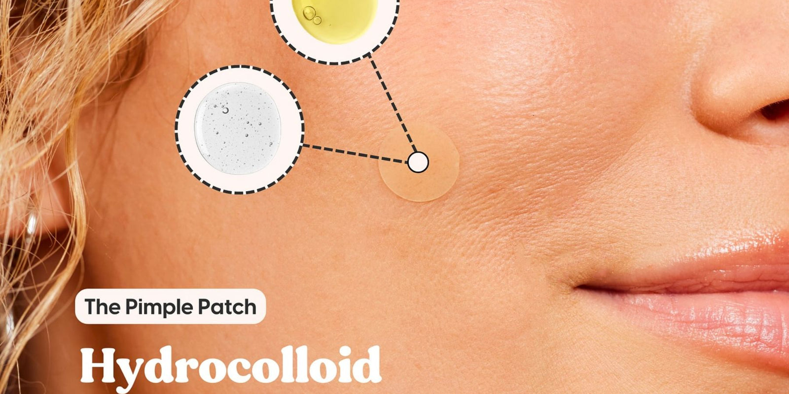 hydrocolloid patches